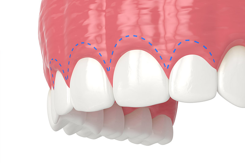 Aesthetic Crown Lengthening in Bellaire